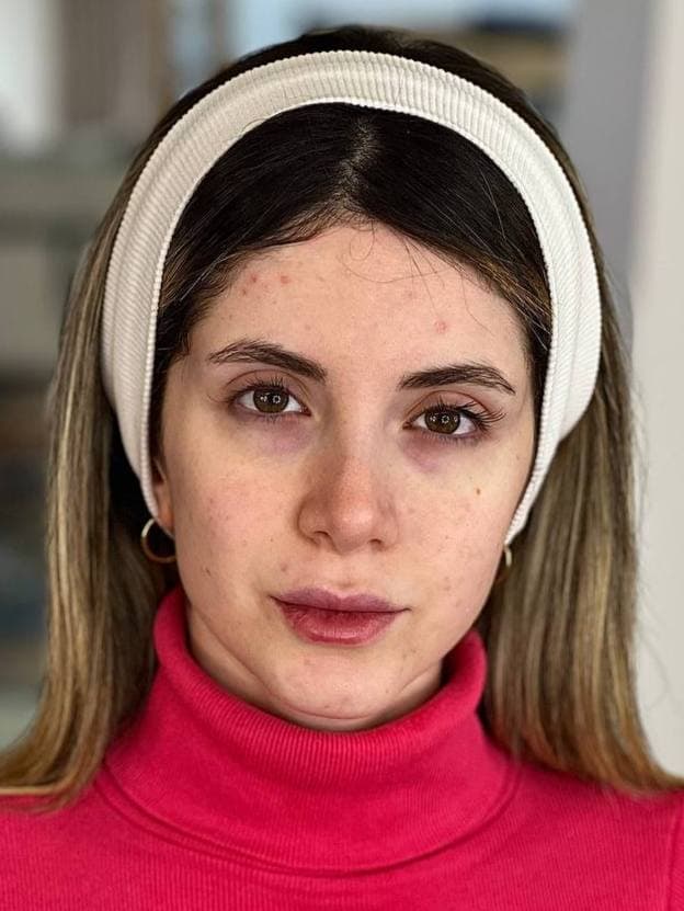 چهره قبل از اجرای میکاپ لایت صورتی در رشت